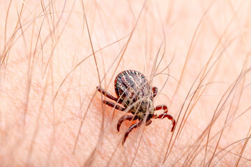 Infectious Encephalitis Tick Insect on Skin. Encephalitis Virus or Lyme Borreliosis Disease Infected Dermacentor Tick Arachnid Mite Parasite Bite.