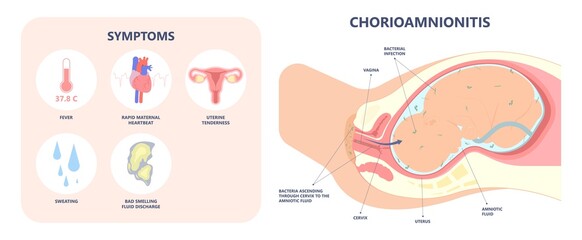 sepsis baby birth preterm labor fetus fluid atony intra bacteria women water breaks mother poly microbial disease urinary tract E. coli genital vagina uterus health Group B Strep amnion Fetal system