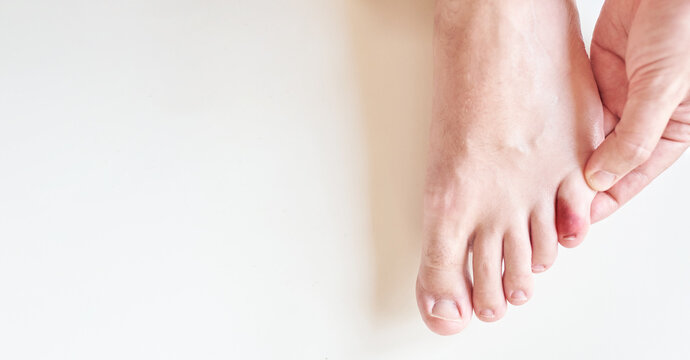 Top view of a little toe injury there is natural light