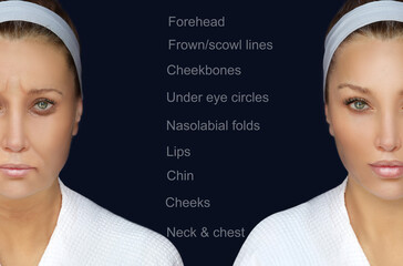dermal filler treatments .Hyaluronic acid injections for specific areas.Effects of...
