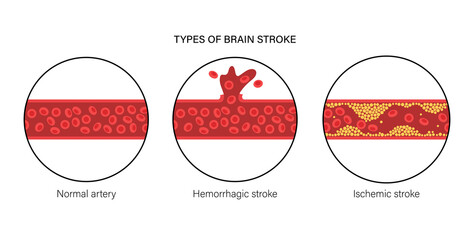 Brain stroke ishemic and hemorrhagic