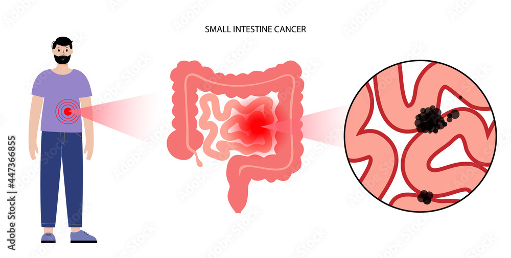 Sticker Small intestine cancer