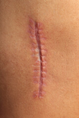 Fototapeta premium Scar on the upper arm. Arm with scar on the upper side . Scar after stitch removal 