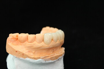 Fototapeta na wymiar Dental crown and veneer in the plaster model