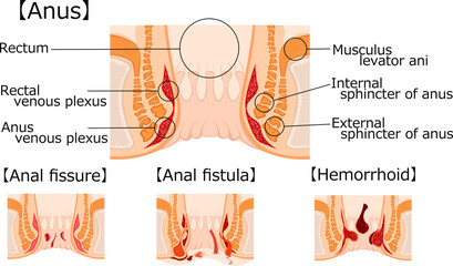 肛門　痔
