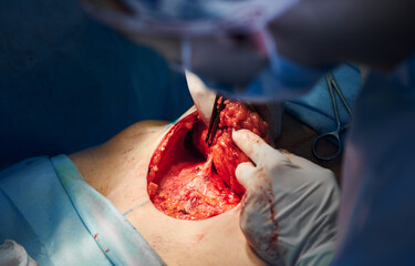 Close up of patient's wound and medical workers hand in sterile gloves doing abdominoplasty surgery. Plastic surgeon and assistant using medical instruments. Concept of medicine, abdominoplasty.