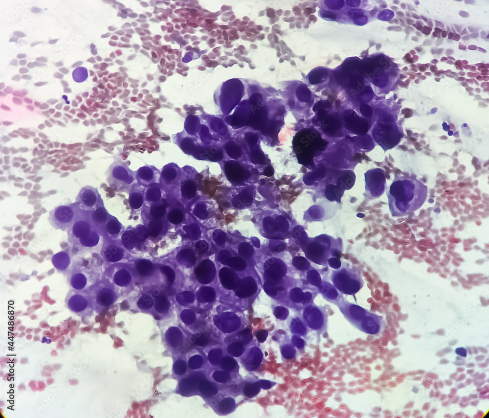 Poster Photomicrograph showing adenocarcinoma of gallbladder. Gallbladder cancer, 40X