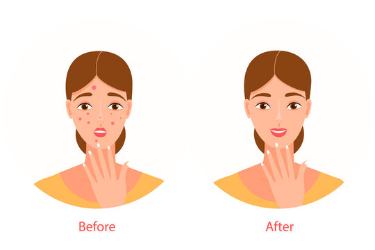 A young beautiful woman with red pimples on her face. Before and after illustration, in a flat cartoon style. The girl is upset, happy. Acne treatment. Vector isolated on a white background