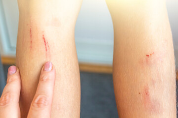 Leg of child with bruise (injury). Pain, hematoma, first aid. Healthcare, сhildren's ambulance...