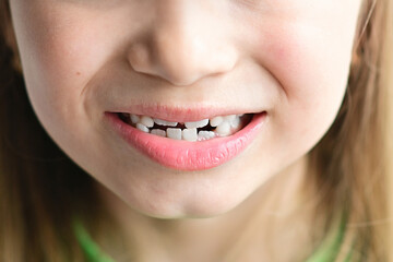First molars and crooked baby teeth of child. Smiling portrait of little blonde girl in close-up. Problems with teeth. Pediatric dentistry.