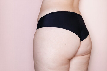woman in black lingerie with cellulite stretch marks
