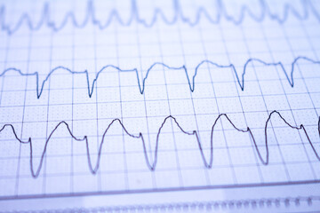 Close-up of heartbeats recorded on the paper of the electrocardiogram. Selective focus. Approach to a cardiac arrhythmia.