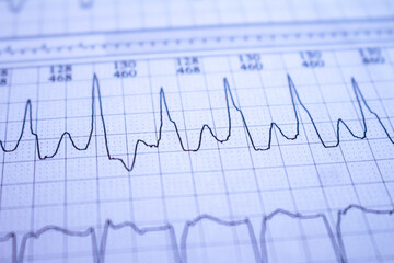 Close-up of heartbeats recorded on the paper of the electrocardiogram. Selective focus. Approach to a cardiac arrhythmia.