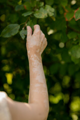 Hand skin pigmentation. White-brown leather. Melasma. Benign pigmentation. Hormonal Disorders. Medical concept.