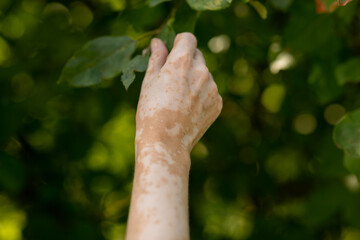 Hand skin pigmentation. White-brown leather. Melasma. Benign pigmentation. Hormonal Disorders. Medical concept.