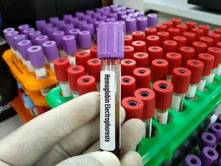Doctor holding blood sample tube ForCBC, Hemogram,HCT, MCV Hematrocrit,MCH, Total count of WBC...
