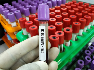 Doctor holding blood sample tube ForCBC, Hemogram,HCT, MCV Hematrocrit,MCH, Total count of WBC...