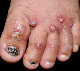 Scabies Infestation with secondary or superimposed bacterial infection and pustules in foot of Southeast Asian, Burmese child. A contagious skin condition caused by mites. - obrazy, fototapety, plakaty