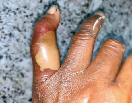 abscess with surrounding cellulitis or Staphylococcal / Streptococcal skin infection at finger of Asian Burmese patient.