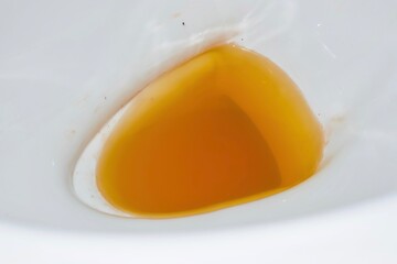 High coloured urine in toilet.