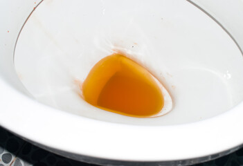 High coloured urine in toilet.