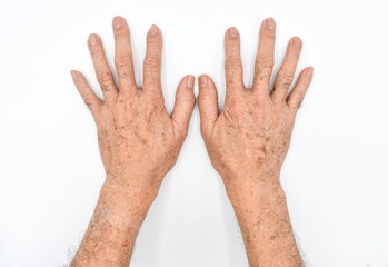 Age spots on hands of Asian elder man. They are brown, gray, or black spots and also called liver...
