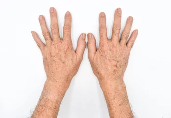 Fotobehang Age spots on hands of Asian elder man. They are brown, gray, or black spots and also called liver spots, senile lentigo, solar lentigines, or sun spots. © ZayNyi