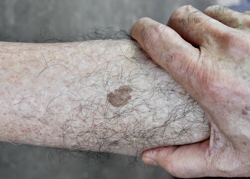 647 Best Liver Spots Images Stock Photos Vectors Adobe Stock 647 Best Liver Spots Images Stock Photos Vectors Adobe Stock