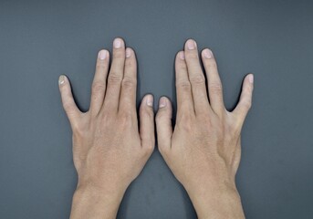Bilateral little finger deviation in Asian young man. Bilateral hand deformities. Abnormal fingers extension. - obrazy, fototapety, plakaty