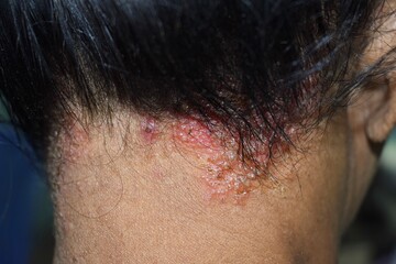 Seborrheic dermatitis or fungal skin infection at the scalp of Southeast Asian, Myanmar adult...