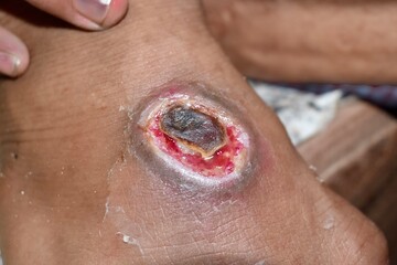 Chronic ulcer or wound on the dorsum of foot in Southeast Asian, burmese, adult male patient. - obrazy, fototapety, plakaty