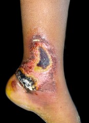Burn wound with granulatuon tissues surrounded by scabs and slight cellulitis in left leg of...