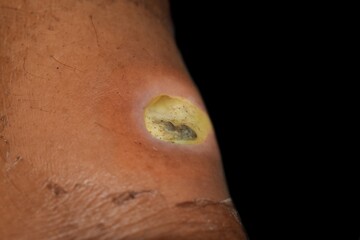 Diabetic ulcer in leg of Asian. patient. Poor wound healing.