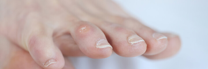 Closeup of dry callus on woman toe