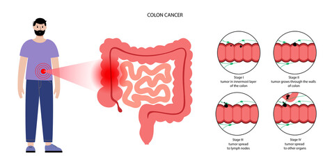 Colon cancer stage