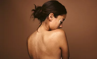 Poster Portrait of woman with skin condition © Jacob Lund
