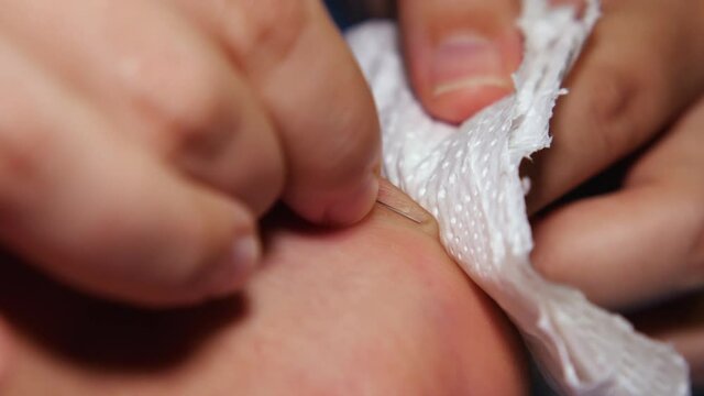 Close-up of fingers with a needle piercing a callus on the leg. The liquid that comes out of the corn is removed with a napkin