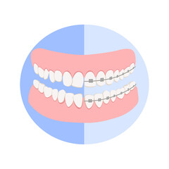 Dental jaw with white teeth before and after braces on the blue background, correct bite of dentition. Dental prosthesis, tooth orthopedics sign, teeth image, icon dental. Vector illustration in flat