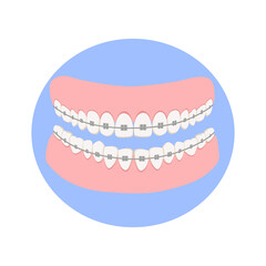 Dental jaw with white teeth with braces on the blue background, correct bite of dentition. Dental prosthesis, tooth orthopedics sign, teeth image, icon dental. Flat vector illustration.