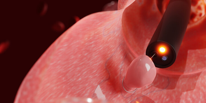 Colon Polyp Removal. Endoscope inside colonoscopy for Colon polyps search. 3d render.