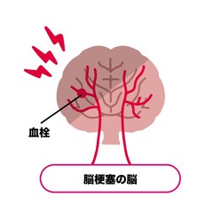 脳梗塞　血栓ができた脳のイラスト素材