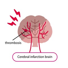 Illustration of a brain with a blood clot
