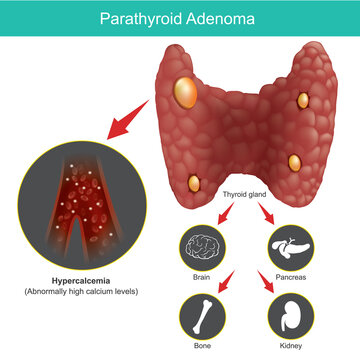 Parathyroid Adenoma. Illustration for explain abnormal thyroid gland and include effects on other organs in human body..