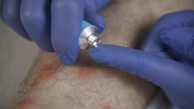 Doctor smears insect bite ointment on patient's leg.