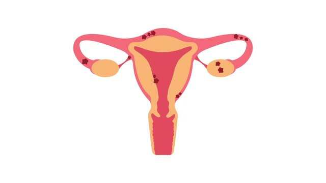 Uterus with endometriosis 2D animation on transparent background. Fertility, human anatomy, female reproductive system. Disease, gynecology, inflammation.
Outside tissue growth medical condition 