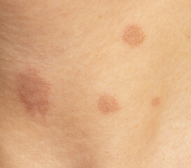 round skin burns from hot oil