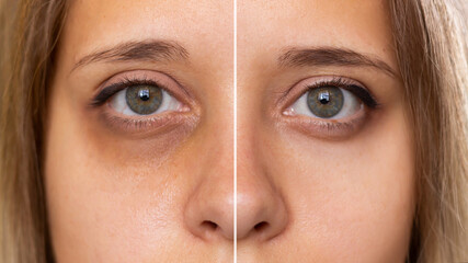 Cropped shot of a young female face. Female green eyes with bruise under eye before and after...