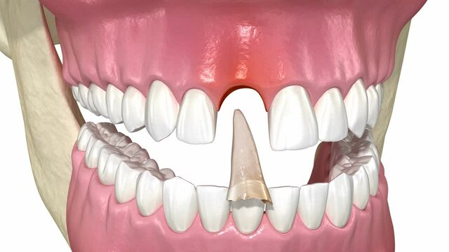 Bone grafting augmentation, socket preservation, tooth implantation. Medically accurate 3D animation.