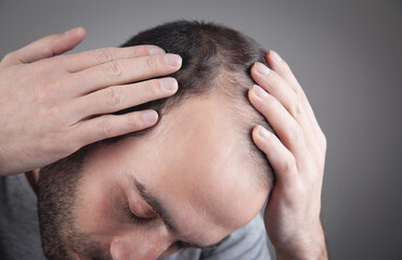 Fototapeta premium Caucasian man checking his hair. Hair loss problem