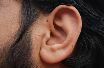Small hole in front of the upper side of the ear which is known as Preauricular Pit. - obrazy, fototapety, plakaty